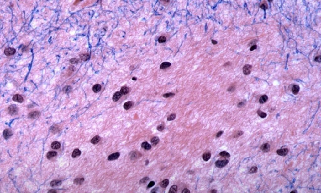 हंटिंग्टन रोग पर बड़ा खुलासा: डीएनए म्यूटेशन कैसे बनता है जानलेवा? Brain tissue in Huntingtons disease - Hindi News Express